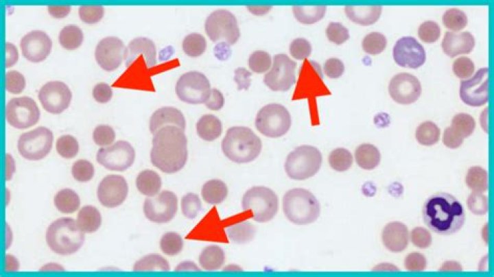 Are smudge cells ever normal