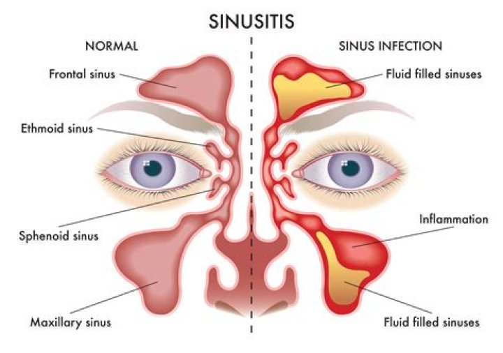 Can bulimia cause ear problems
