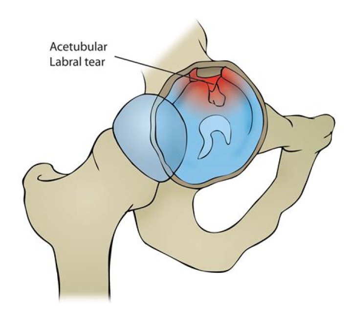 Does a labrum tear require surgery