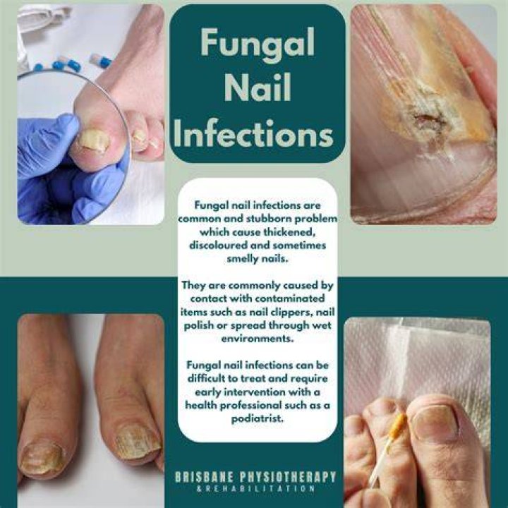 Does fungi nail work on fingernails