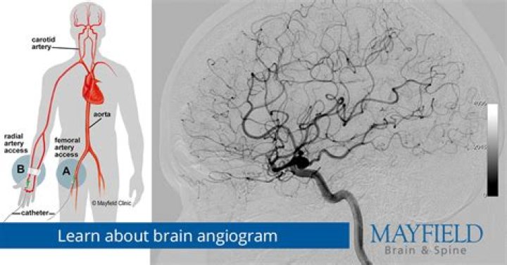 How and why an angiogram is obtained