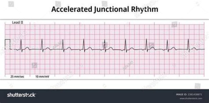 How is junctional rhythm treated