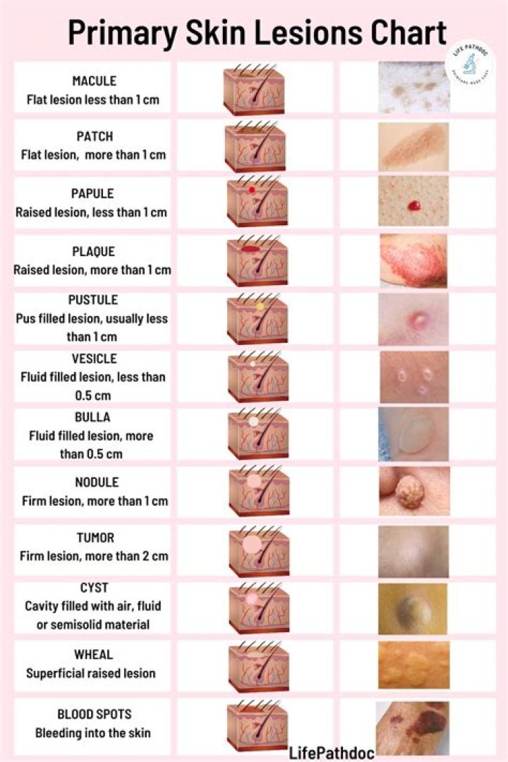 What are primary lesions