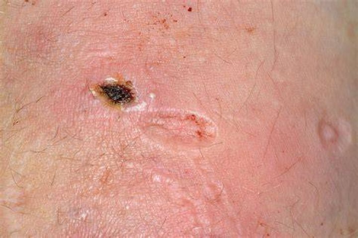 What do cigarette burn scars look like