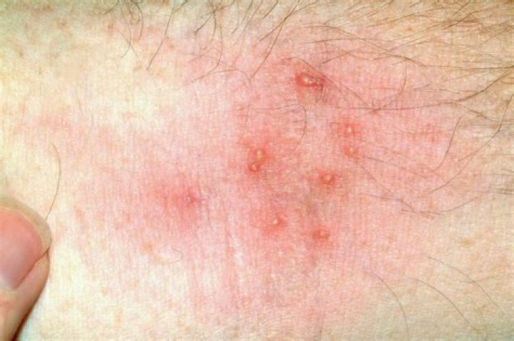 What do oak tree mite bites look like