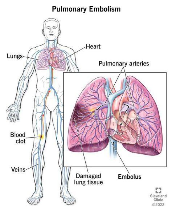 What is a massive pulmonary embolism