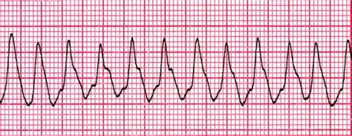 What is a vector ECG