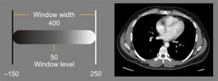 Which is a typical soft tissue window setting